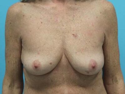 Breast Augmentation