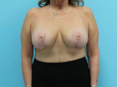 Augmentation & Mastopexy