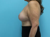 Augmentation & Mastopexy