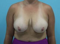 Augmentation & Mastopexy