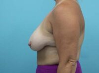 Augmentation & Mastopexy