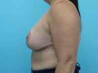 Augmentation & Mastopexy