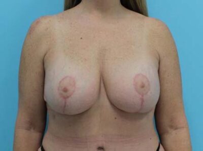 Augmentation & Mastopexy