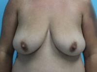 Augmentation & Mastopexy