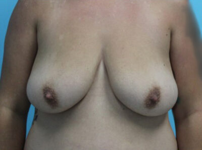 Augmentation & Mastopexy