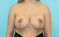 Augmentation & Mastopexy