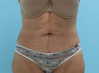 Abdominoplasty