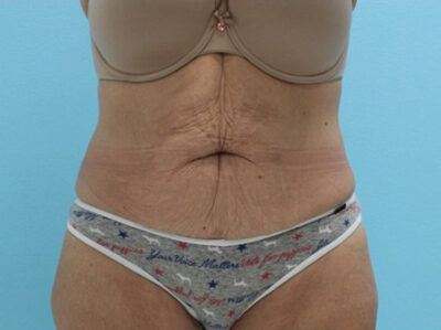 Abdominoplasty