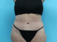 Abdominoplasty