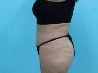 Abdominoplasty