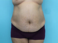 Abdominoplasty