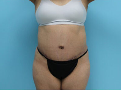 Abdominoplasty