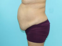 Abdominoplasty