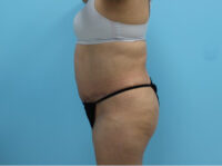 Abdominoplasty