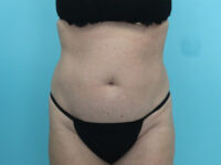 Abdominoplasty