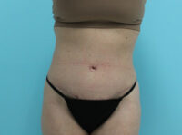 Abdominoplasty