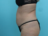 Abdominoplasty