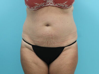 Abdominoplasty