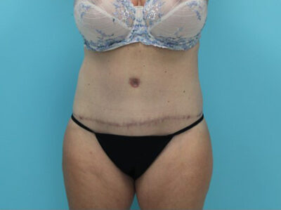 Abdominoplasty