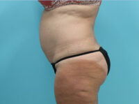 Abdominoplasty