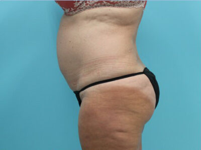 Abdominoplasty