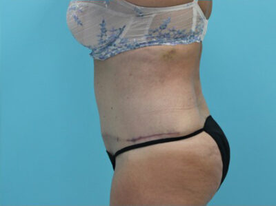 Abdominoplasty