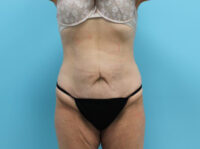 Abdominoplasty