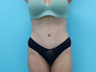 Abdominoplasty