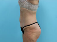 Abdominoplasty