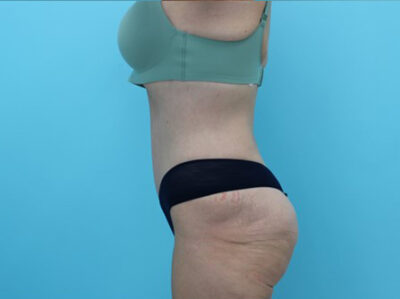 Abdominoplasty