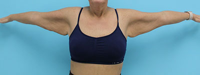 Brachioplasty
