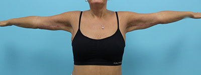 Brachioplasty