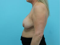 Augmentation & Mastopexy