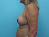 Augmentation & Mastopexy
