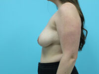 Augmentation & Mastopexy