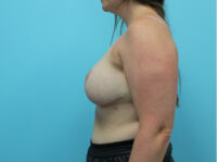 Augmentation & Mastopexy