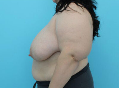 Breast Reduction