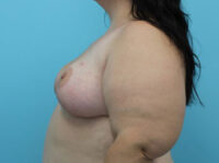 Breast Reduction