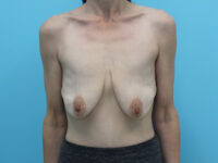 Augmentation & Mastopexy
