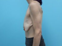 Augmentation & Mastopexy