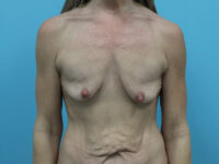 Augmentation & Mastopexy