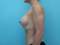 Breast Augmentation