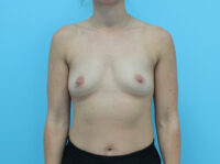 Breast Augmentation