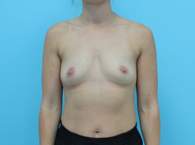 Breast Augmentation