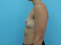 Breast Augmentation