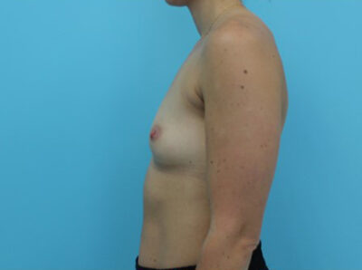 Breast Augmentation