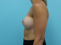 Breast Augmentation