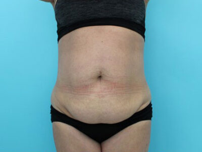 Abdominoplasty
