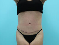 Abdominoplasty