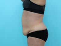 Abdominoplasty